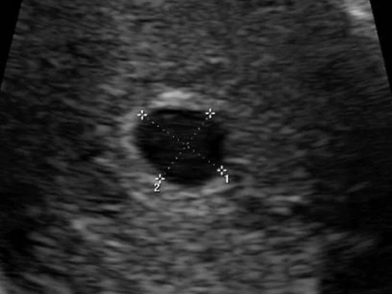 Graviditet uge 4 - hvornår kan man få en tidlig scanning