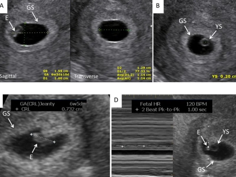 Hvad kan man se ved en tidlig ultralydscanning