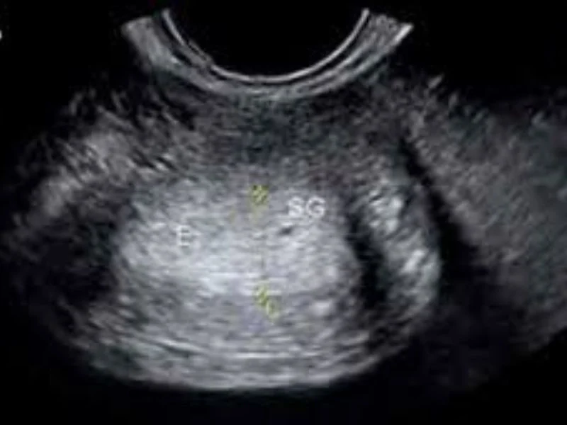 Tidlig graviditetsscanning - ultralydsbillede af tidlig graviditet