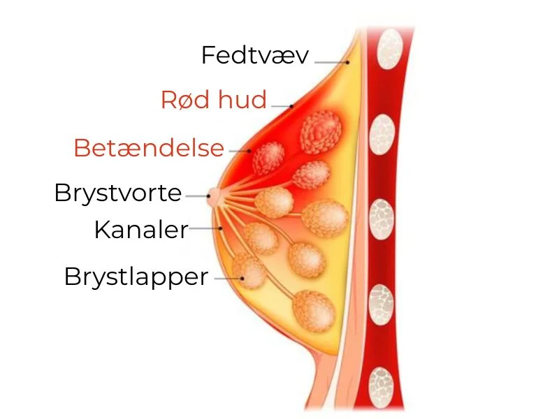 Forståelse af brystbetændelse