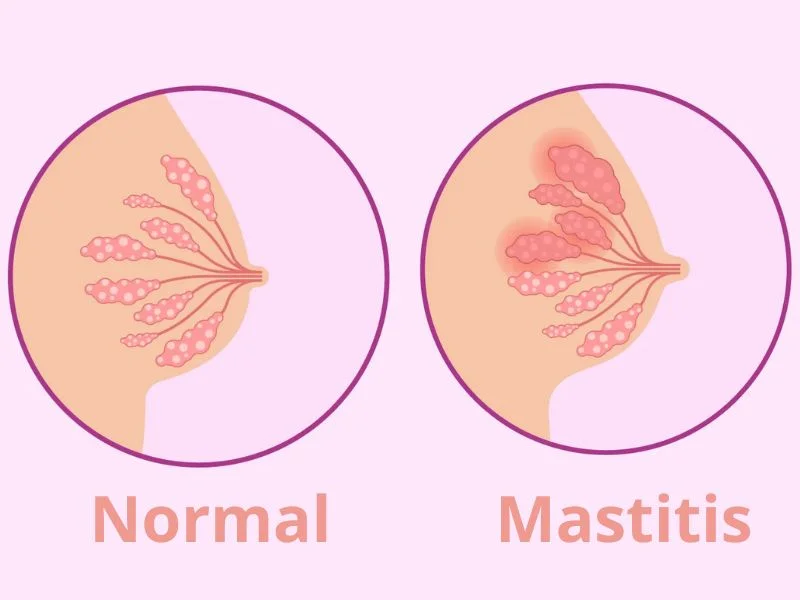 Symptomer på brystbetændelse
